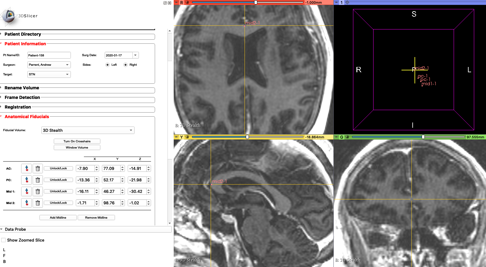 ../_images/Mid2Markup.png